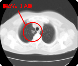 低線量肺がんCT検診 – 公益財団法人宮崎県健康づくり協会